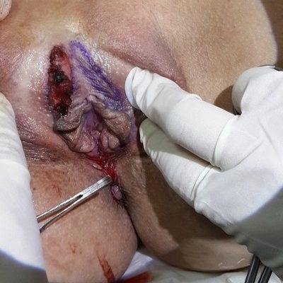 Labioplastia, lipotransferencia autologa, cirugía vaginal, relleno de labios, reducción de labios redundantes