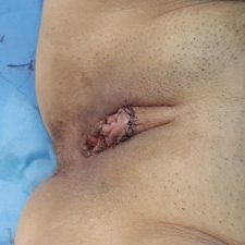 Labioplastia, lipotransferencia autologa, cirugía vaginal, relleno de labios, reducción de labios redundantes